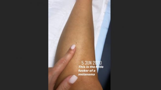 Titik yang ternyata kanker kulit. (Dok: Instagram/LouHayhay)