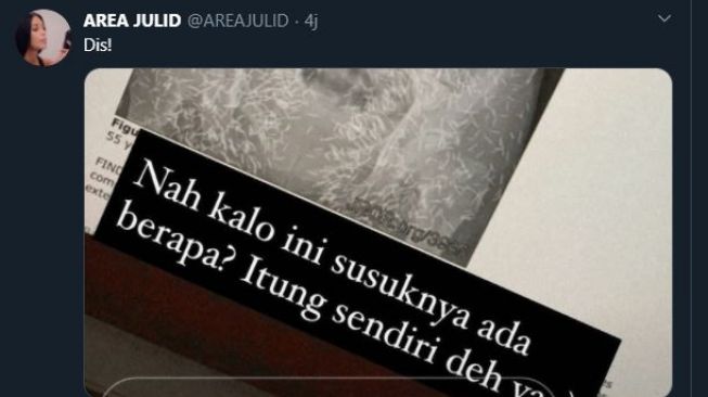 Sebuah foto X-Ray yang menangkap adanya susuk di tubuh seorang pasien. (Twitter/@AREAJULID)