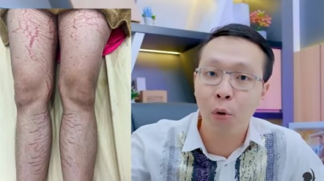 dr Richard Lee, MARS menunjukkan kulit kaki yang mengalami strech mark parah akibat menggunakan body lotion yang mengandung steroid dalam jangka panjang. (YouTube/dr Richard Lee, MARS)