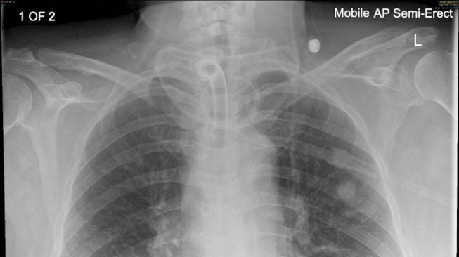 Hasil CT Scan paru-paru sang pria (BMJ Journal)