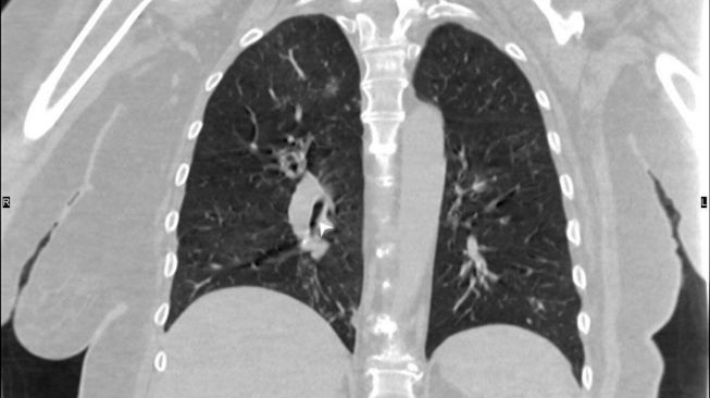 Tes swab tertinggal di paru-paru. [BMJ Case report]