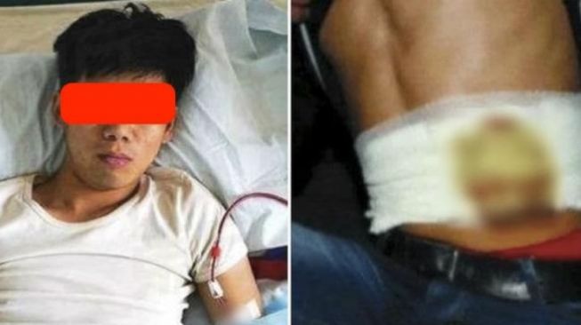 Remaja Tiongkok, Wang Shangkun yang kini hanya bisa tergolek di ranjang setelah menjual ginjalnya. (Foto: iDropNews)