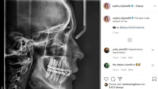 Sophia Latjuba mengunggah foto rontgen kepalanya. [Instagram]