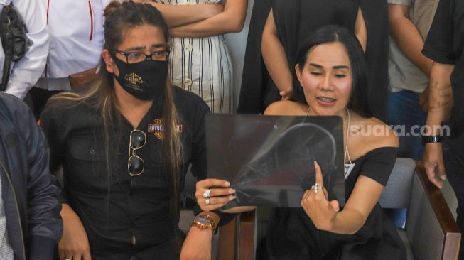 Adrena Isa Zega (kanan) menunjukkan hasil gambar ronsen bagian hidung yang terluka akibat aksi pemukulan yang menimpa dirinya saat menggelar konferensi pers di Tebet, Jakarta Selatan, Senin (9/11). [Suara.com/Alfian Winanto]