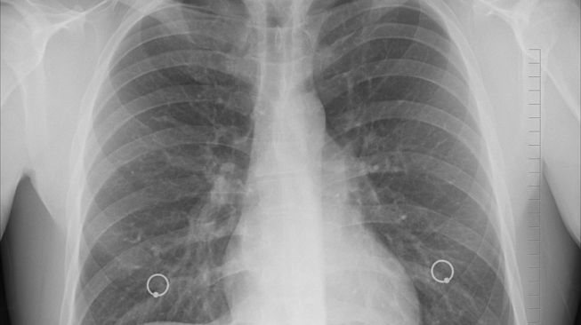 Illustration of a lung, pneumonia (Pixabay/oracast)