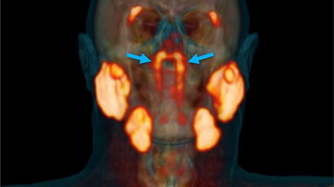 Kelenjar tersembunyi. [Radiotherapy and Oncology]