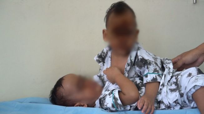 Bayi Kembar Siam Jalani Operasi Pemisahan di RSUP Adam Malik Hari Ini