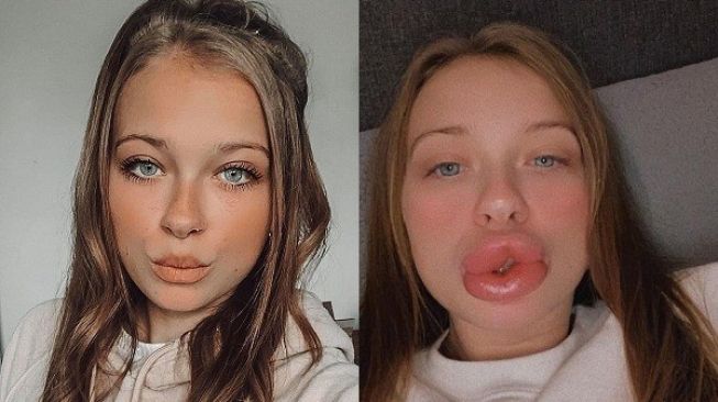Tergiur Iklan Filer di Facebook, Bibir Wanita Ini Berubah Jadi Mengerikan