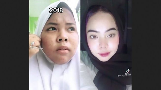 Kisahnya Viral, Remaja Ini Ungkap Rahasia Wajah Glowing Bebas Jerawat. (TikTok/@kitkatgreenteaaaaa)