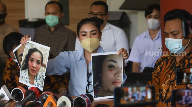 Penyanyi Nindy Ayunda menunjukkan bukti dugaan KDRT yang diterimanya dari sang suami, Askara Parasady Harsono saat menggelar konferensi pers di Kantor Komnas Perempuan, Jakarta Pusat, Selasa (16/2/2021). [Suara.com/Alfian Winanto]