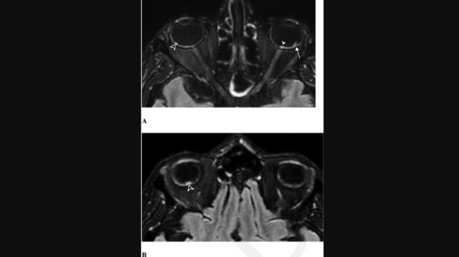 Hasil MRI pada mata pasien Covid-19 parah (Jurnal Radiology)