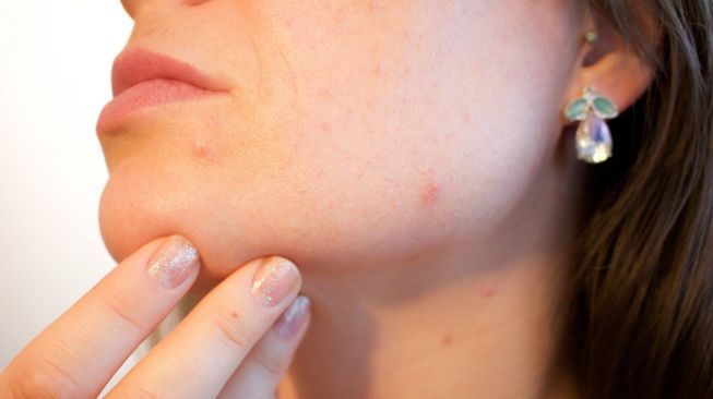 9 Cara Menghilangkan Jerawat dalam Rutinitas Skincare, Kuncinya Jangan Malas