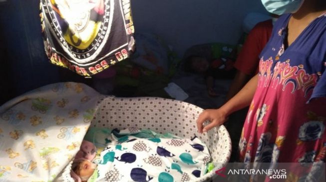 Hanya Bertahan 22 Hari, Bayi Tanpa Tempurung Asal Solo Meninggal