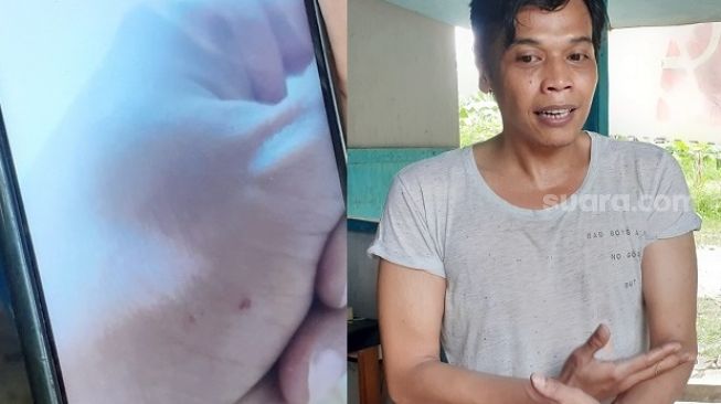 Faisal Rahman (kanan) dipatok ular kobra di bagian tangan kirinya (kiri) di kediamannya di Perumahan Kluster New Paradiso, Kecamatan Ciputat, Tangsel, saat ditemui SuaraJakarta.id, Jumat (2/4/2021). [Suara.com/Wivy]