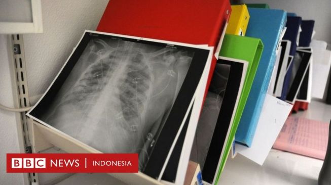 Pasien Covid-19 di Jepang Penerima Pertama Cangkok Paru dari Pendonor Hidup