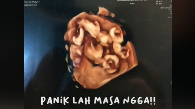 Dapat Jackpot Ikut Program Bayi Tabung, Pasutri Panik Pas Lihat Hasil USG