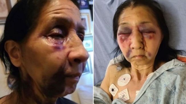 Disangka Keturunan Asia, Seorang Nenek Dianiaya hingga Patah Hidung