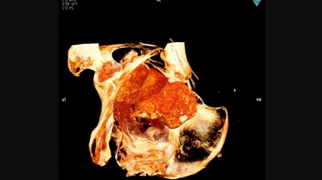 Pertama kali ditemukan mumi hamil. [Science in Poland]