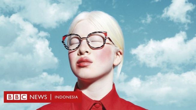 Kisah Perempuan Albinisme yang Dibuang Saat Bayi, Kini Jadi Model Vogue