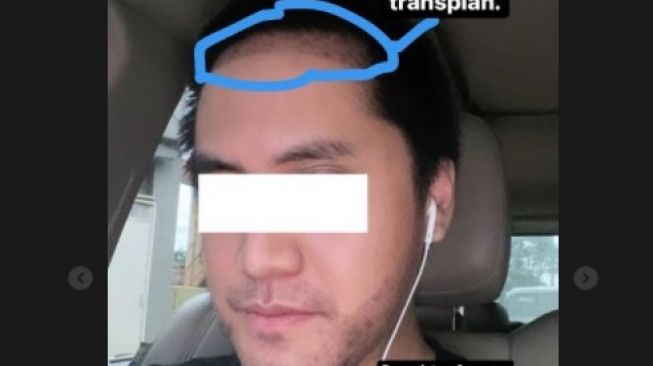 Kevin Aprilio bocorkan gaya baru usai transplantasi rambut. (Instagram)