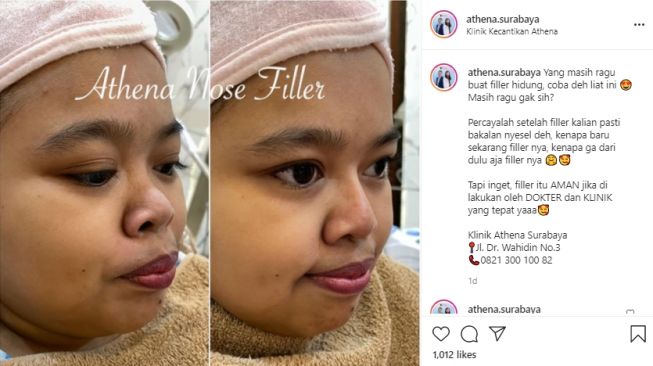 Kekeyi Filler Hidung, Ketahui Persiapan sebelum Melakukan Prosedur Kecantikan Ini