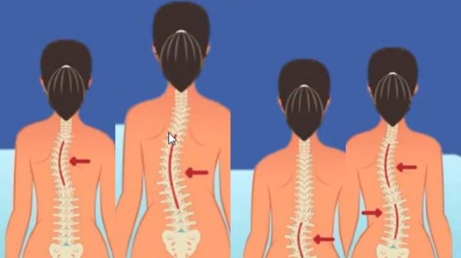Ketahui Jenis-jenis Skoliosis atau Kelainan Tulang Belakang