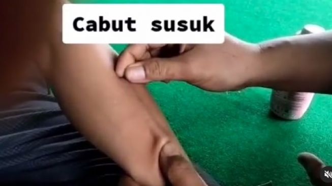 Viral Video Proses Cabut Susuk Bikin Ngilu, Ini Penjelasan Ilmiahnya