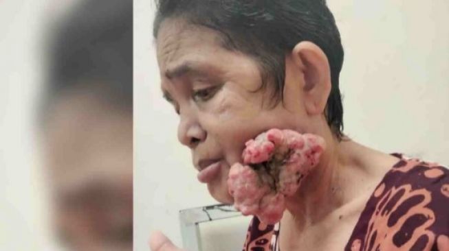 Kumpulan Berita KANKER KULIT GANAS: Innalilllahi Ibu Jaina Menderita