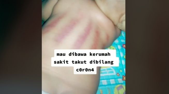 Ibu sakit hati lihat bayinya kesakitan saat dikerok (tiktok)