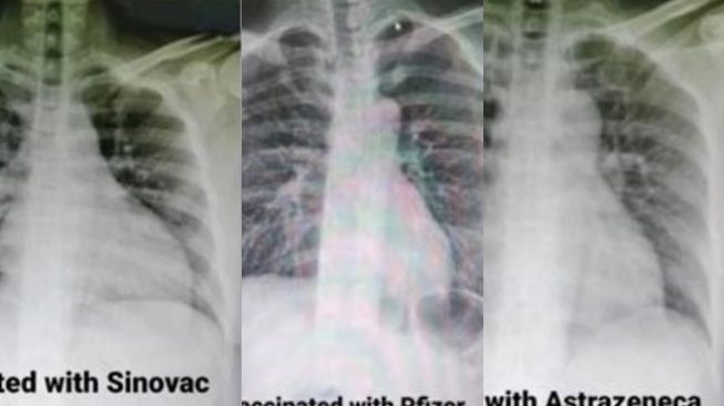 Viral Foto Paru-paru Pasien COVID-19 Setelah Divaksin Sinovac, Astrazeneca, dan Pfizer