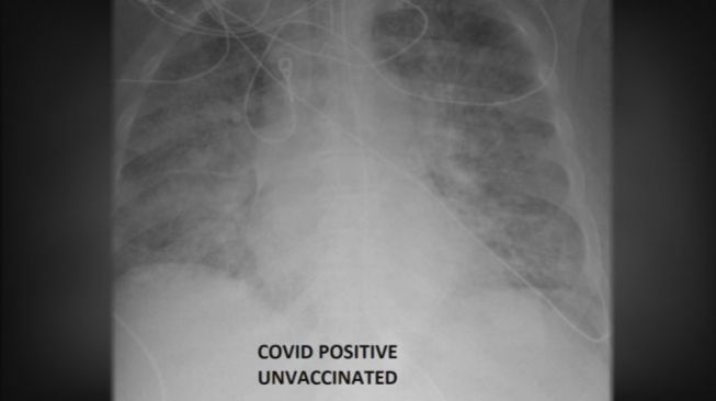 Penampakan paru-paru pasien positif Covid-19 belum vaksinasi. [KSDK]