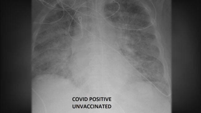 Penampakan paru-paru pasien positif Covid-19 sudah vaksinasi. [KSDK]