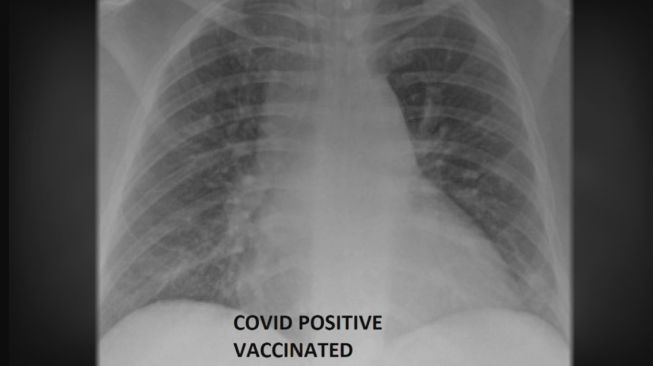 Penampakan paru-paru pasien positif Covid-19 sudah vaksinasi. [KSDK]