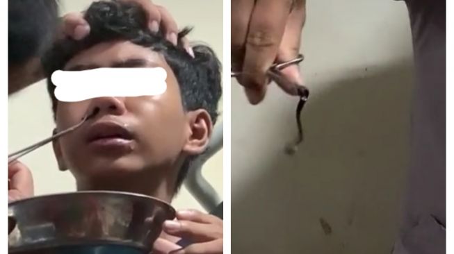 Sering Ngeluh Mimisan, Pas Dicek Ternyata Ada yang Bersarang di Hidung (tiktok)