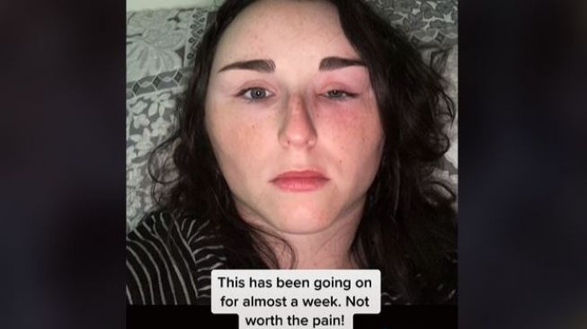 Wanita Ini Kapok Mengecat Rambut, Wajah Bengkak Mirip Alien karena Lupa Tes Alergi