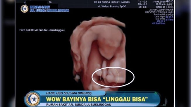 Viral Foto USG Bayi Berpose Acungi Jempol Simbol 'Oke', Wali Kota Sampai Angkat Bicara