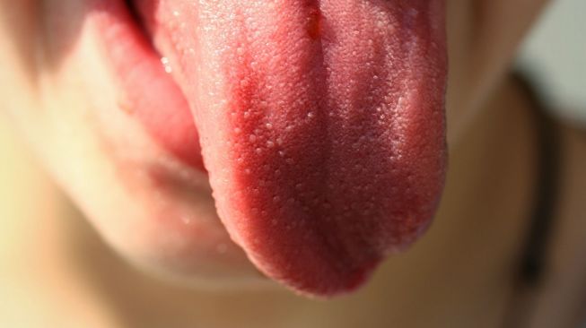 5 Penyebab Bintik-Bintik Di Lidah, Tanda Infeksi Menular Seksual?