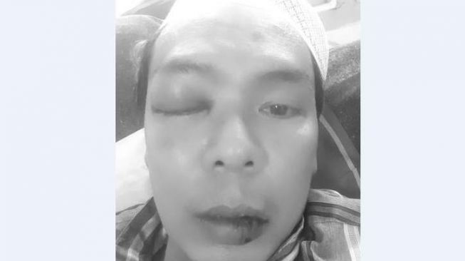 Penampakan wajah Very Idham Henyansyah alias Ryan Jombang setelah dipukul Habib Bahar bin Smith. (Solopos/Istimewa)