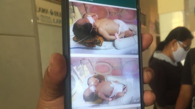 Staf RSUD dr Seoselo Kabupaten Tegal menunjukkan foto bayi kembar siam yang sedang dirawat intensif, Sabtu (21/8/2021)‎. [Suara.com/F Firdaus]