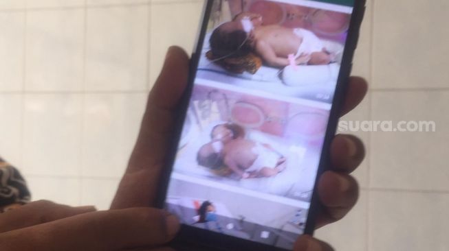 Kabar Duka, Bayi Kembar Siam di Tegal Akhirnya Meninggal Dunia