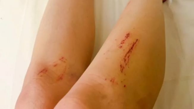 Ayu Thalia perlihatkan kaki memar di Instagram Story [Instagram/@thata_anma]