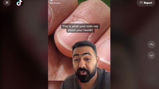 Viral di TikTok! Dokter Ini Ungkap Tampilan Kuku yang Jadi Tanda Penyakit Bahaya