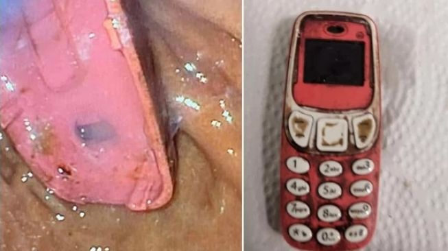 Heboh! Lelaki Ini Dilarikan ke RS Gegara Telan Handphone Nokia 3310