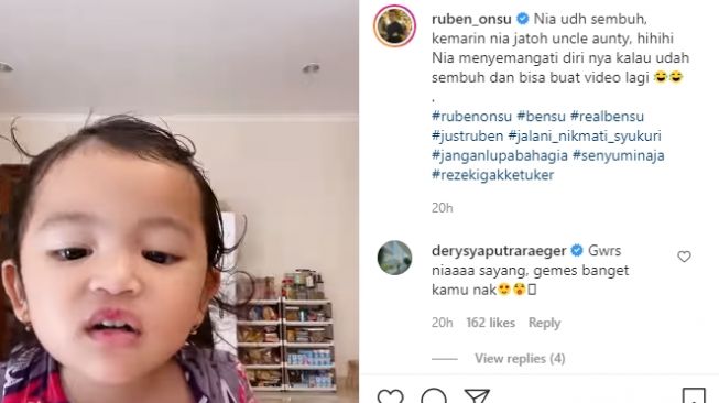 Anak Ruben Onsu, Thania Putri Onsu yang memperlihatkan luka di bibir [Instagram/@ruben_onsu]