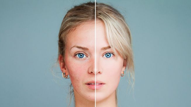 5 Kandungan Skincare yang Ampuh untuk Bekas Jerawat