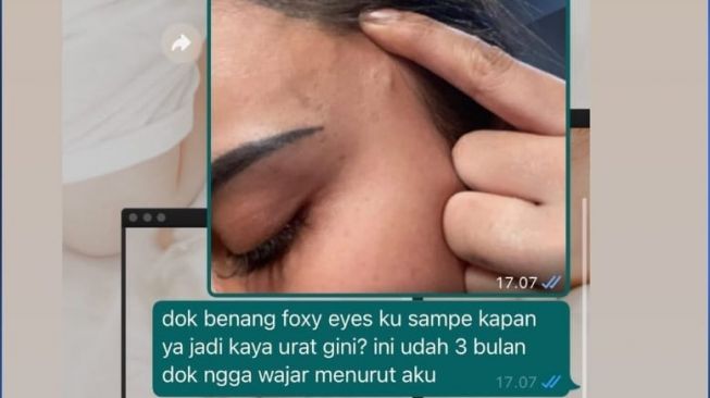 Anggita Sari memperlihatkan benang menonjol di bagian dahi [Instagram:/@anggitasari612]