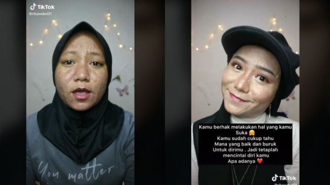 Sering Diejek karena Wajah Penuh Bekas Jerawat, Gaya Pede Wanita Ini Panen Pujian