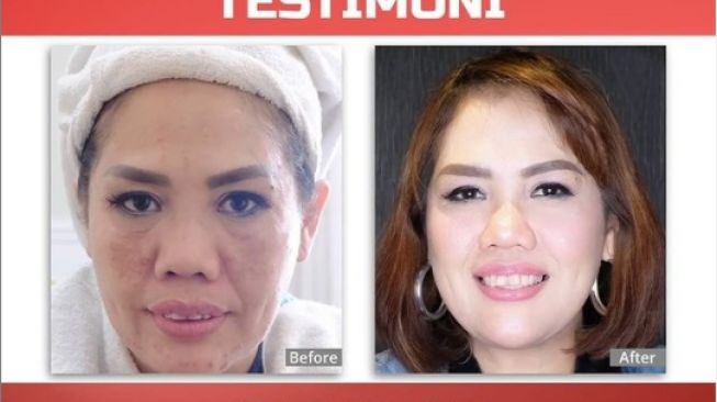 Foto Elly Sugigi sebelum dan sesudah perawatan. [Instagram/medglowclinicjogja]