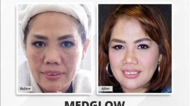 Foto Elly Sugigi sebelum dan sesudah perawatan. [Instagram/medglowclinicjogja]