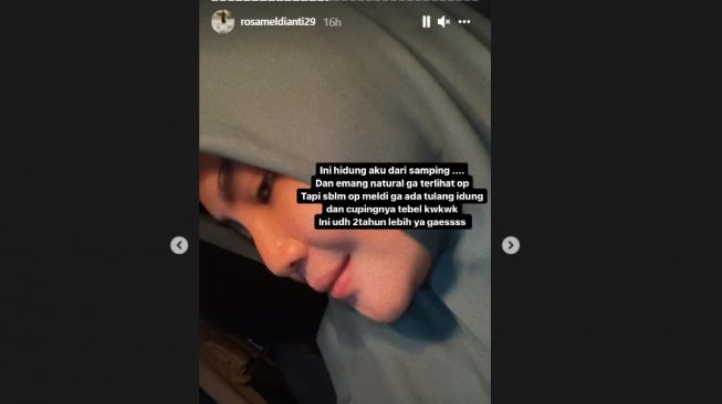 Unggahan Rosa Meldianti soal operasi hidung. [Instagram/rosameldianti29]